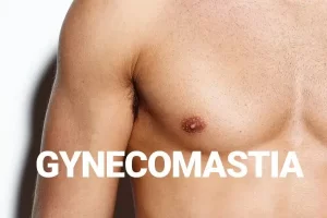 adult gynecomastia