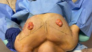 EXCISION OF BREAST GLANDS IN GYNECOMASTIA