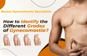 how to identify gyno grades