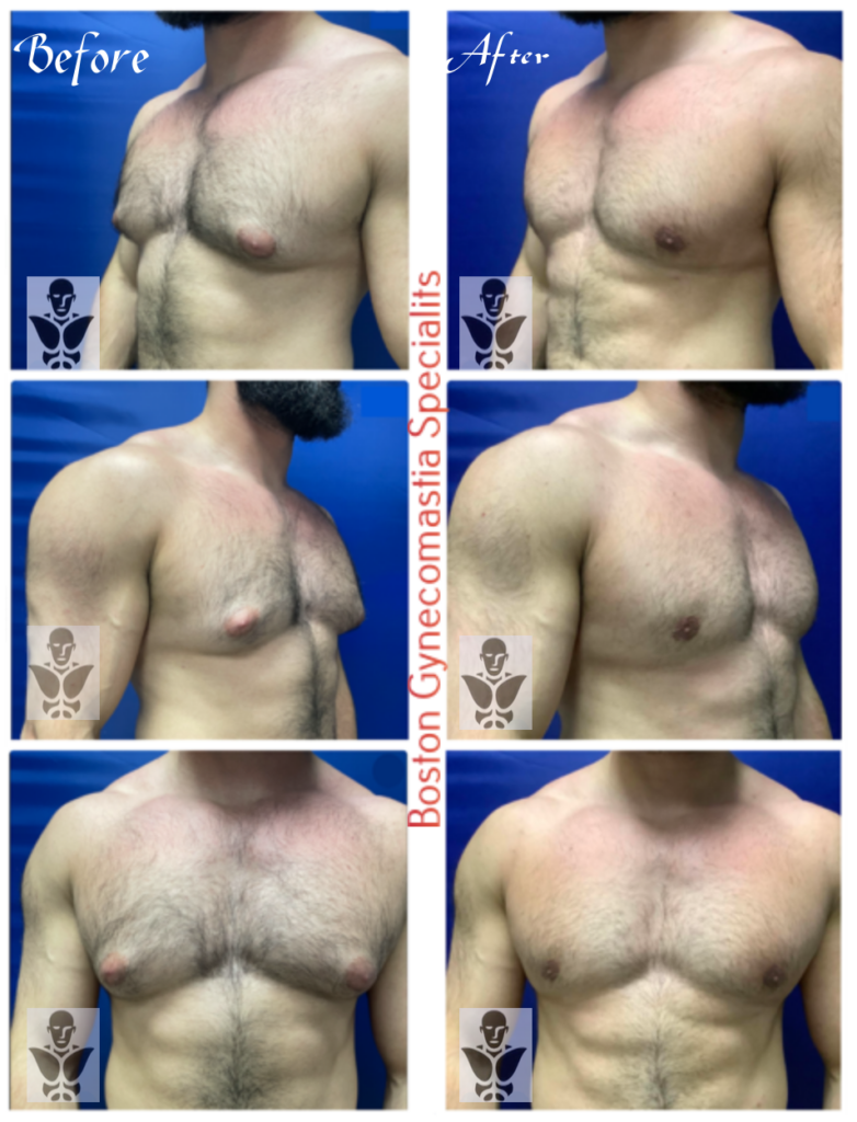 body builder gynecomastia surgery result boston