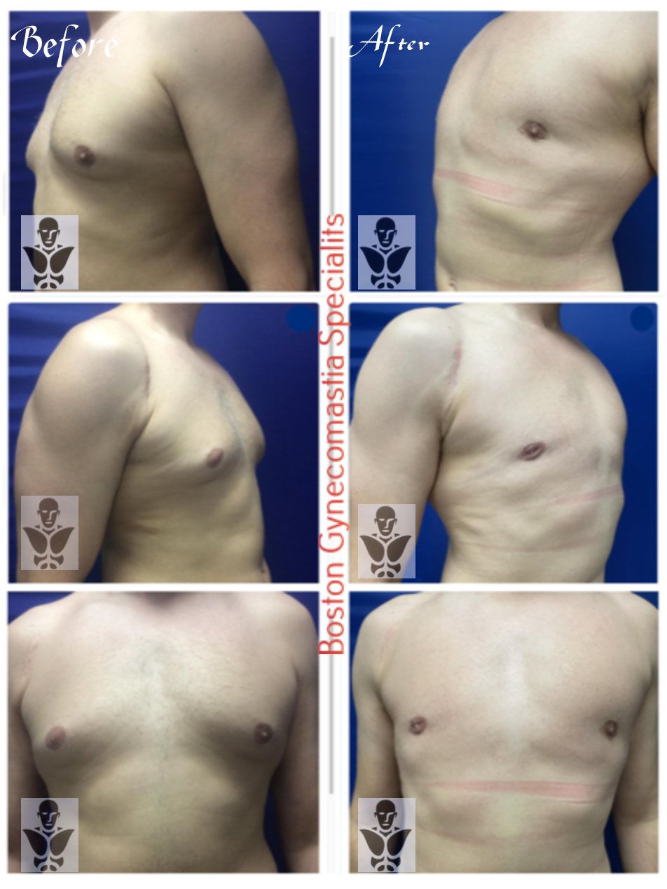 adult gynecomastia surgery result Boston