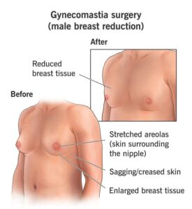 understanding gyno surgery