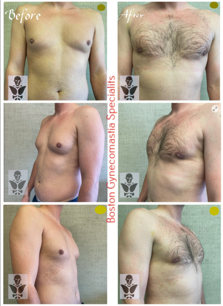 Dr Ishoo Gynecomastia Surgery Results