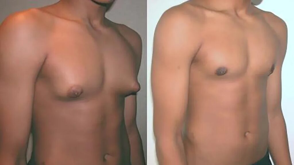 Boston Gynecomastia Surgery Result