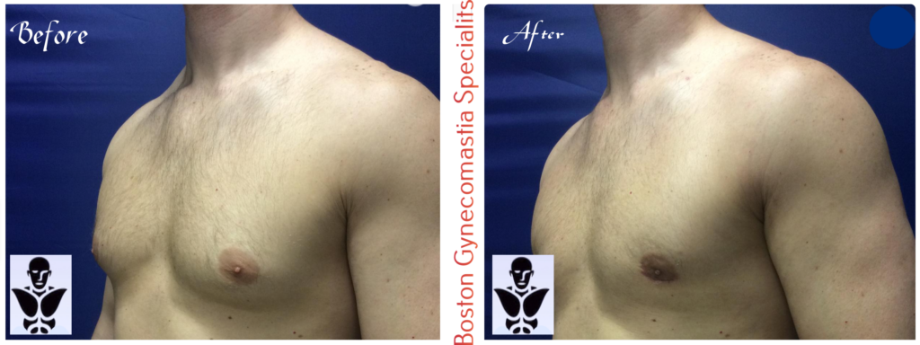 Boston Gynecomastia Surgery Result