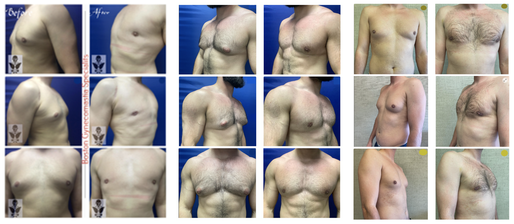 compilation gynecomastia surgery results