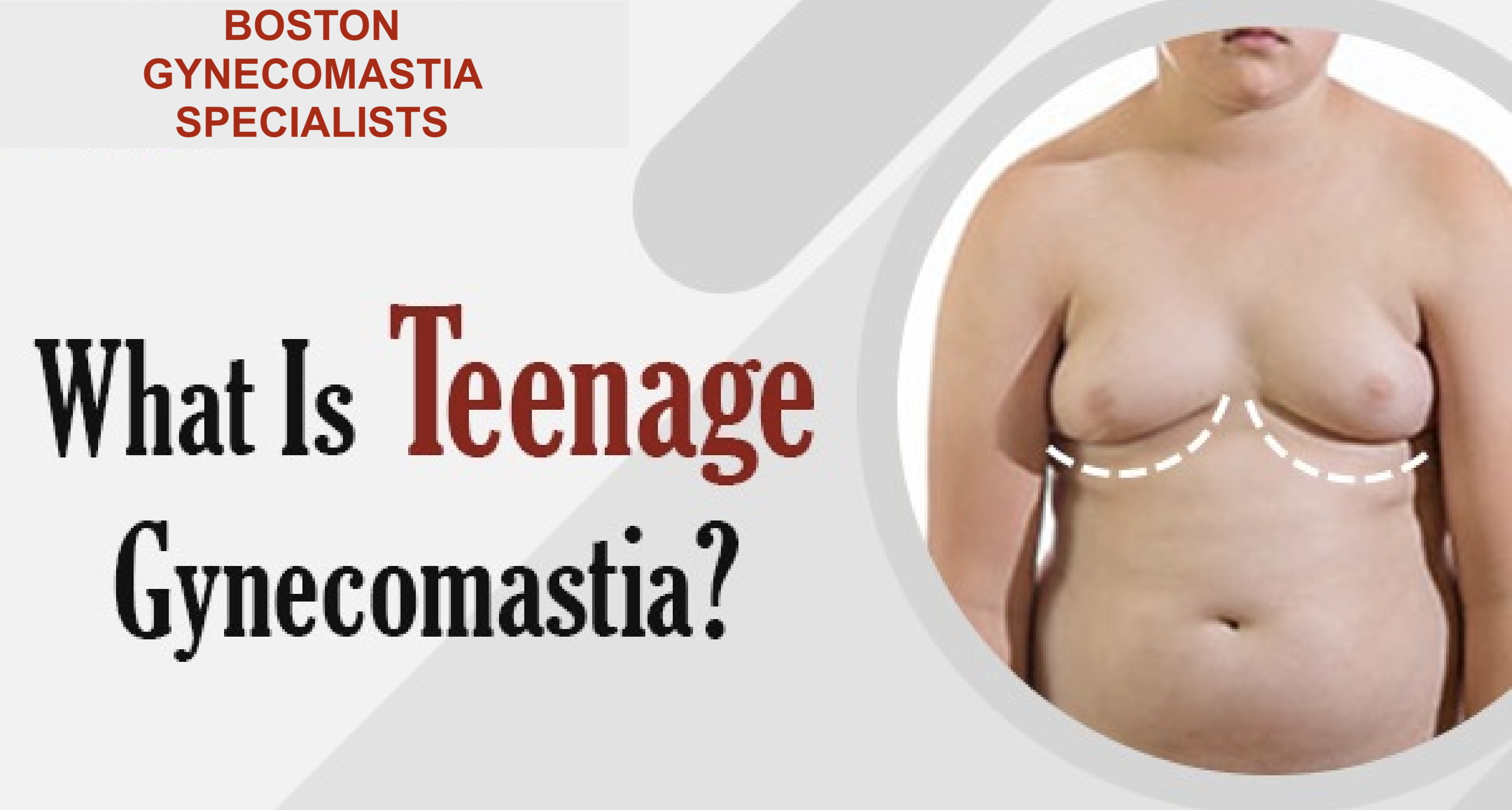 Adolescent Puberty Gynecomstia