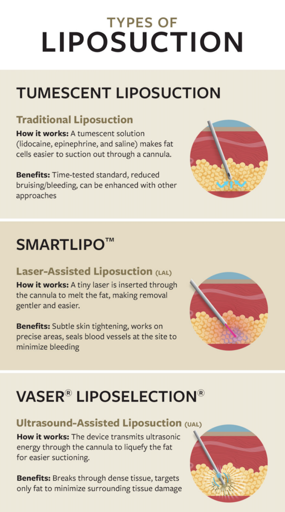 Types of Liposuction for Gynecomastia Treatment