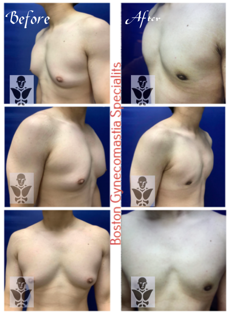 Boston Gynecomastia Surgery results