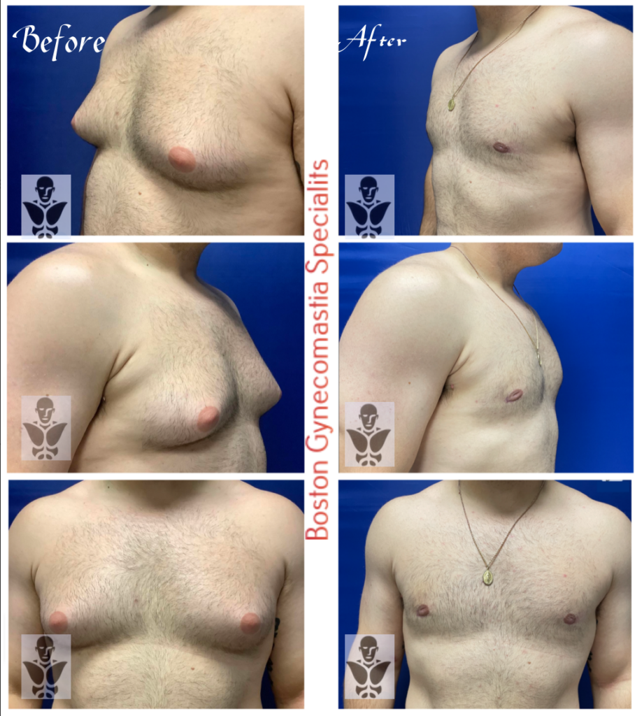 Dr Ishoo Gynecomastia Surgery Result