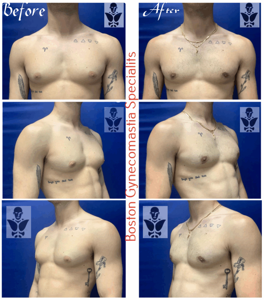 Puffy Nipples Surgery in Boston 4 puffy nipples surgical results
