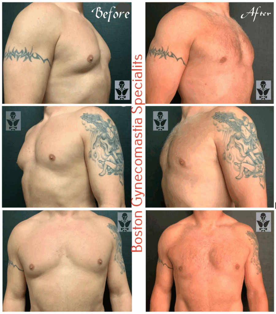 Adult Gynecomastia Surgery in Boston 3 Grade II gynecomastia treatment result in Boston