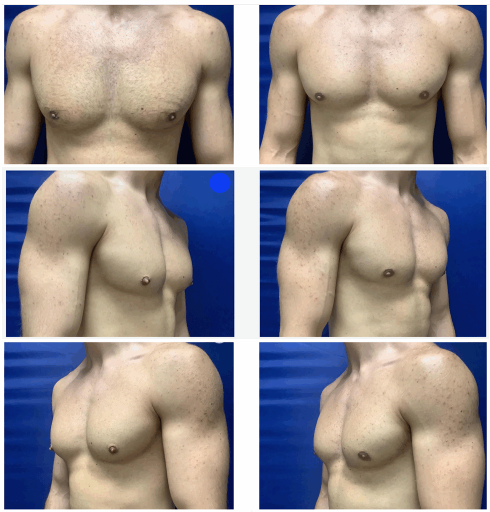 Surgical excision of puffy nipples
