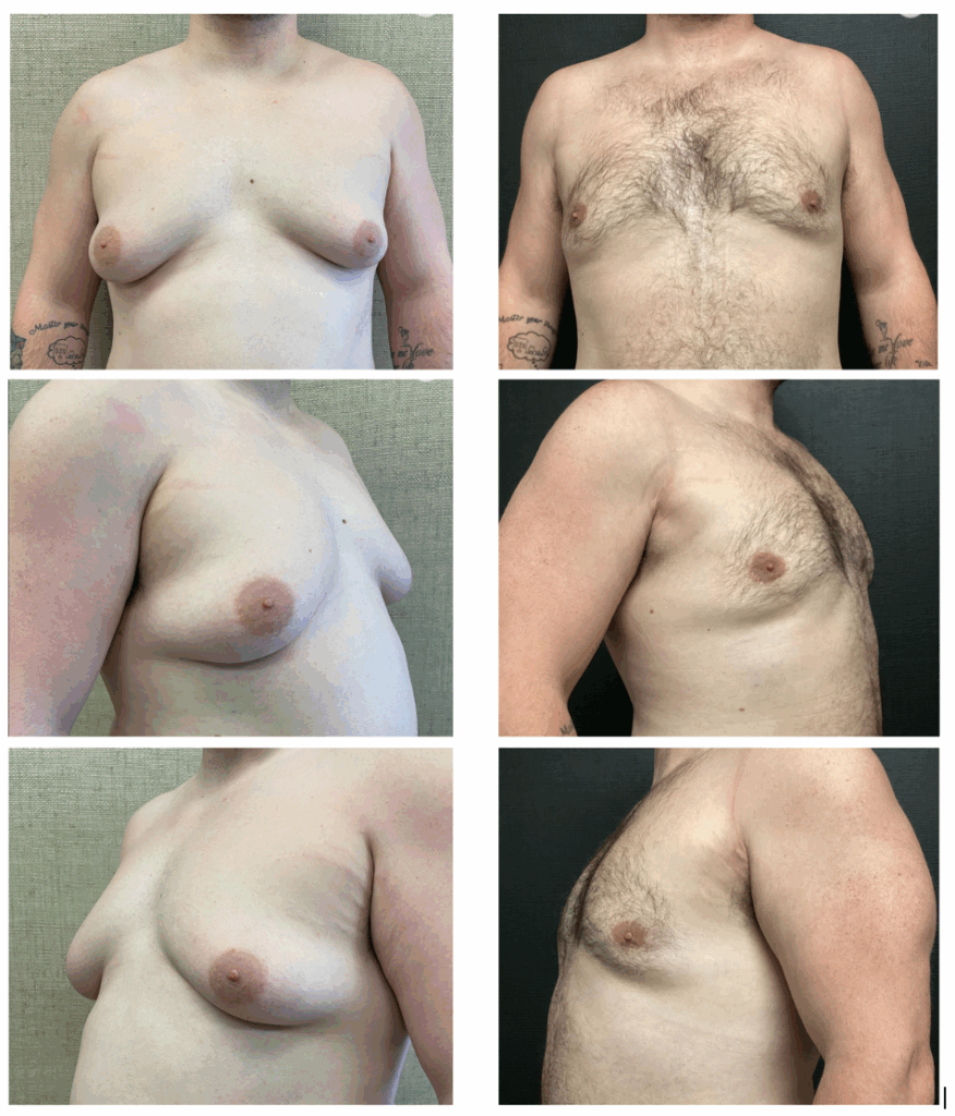Boston gynecomastia specialists JW results