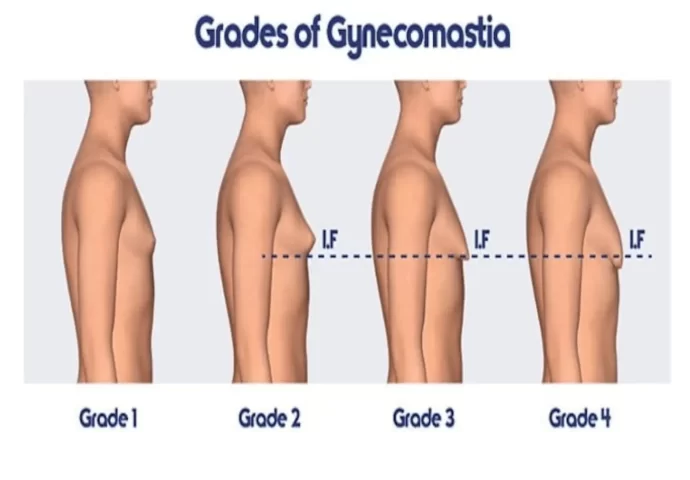 28-FOUR-GRADES-OF-GYNECOMSTIA