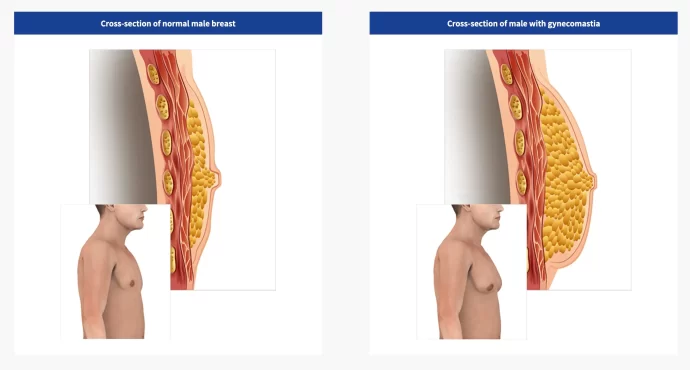 Gynecomastia cross section