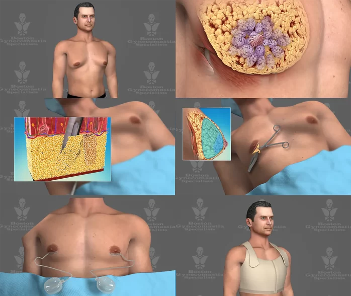 Gynecomastia surgery images