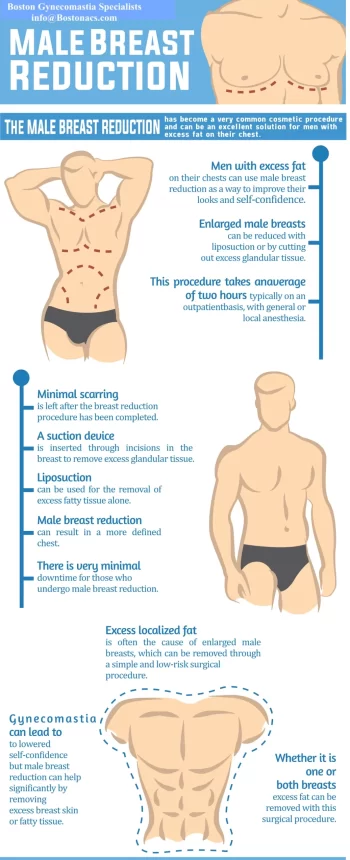 Gynecomastia procedure infographic