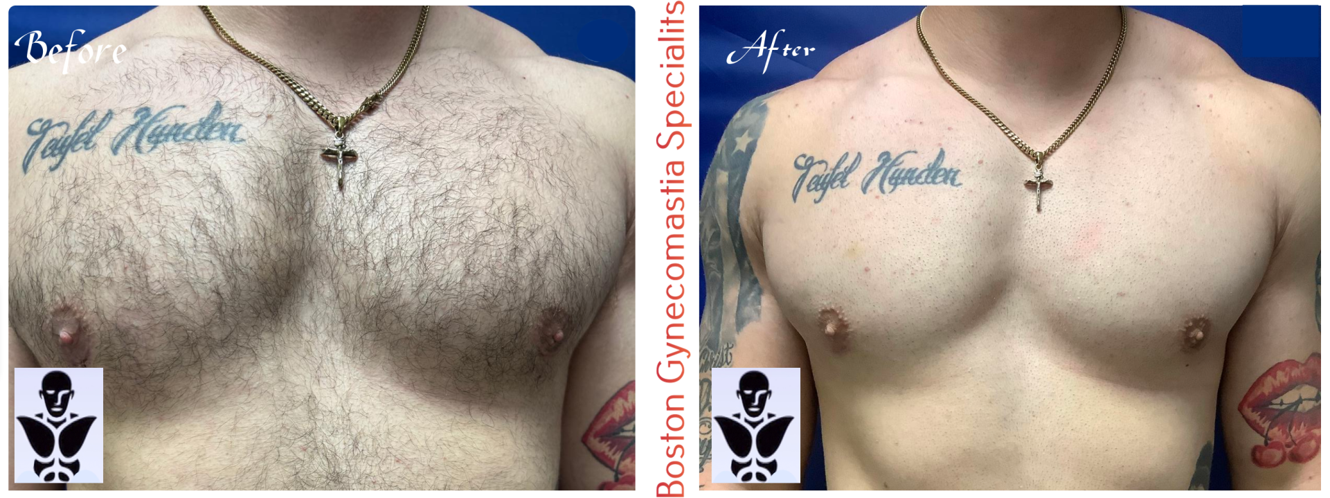 Boston gynecomastia specialists GYNO BA 9