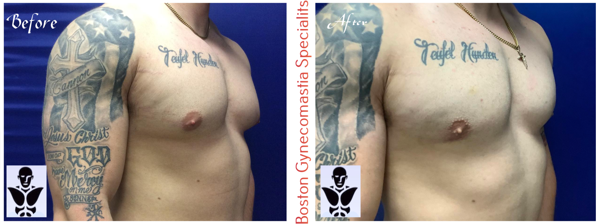 Boston gynecomastia specialists GYNO BA 13