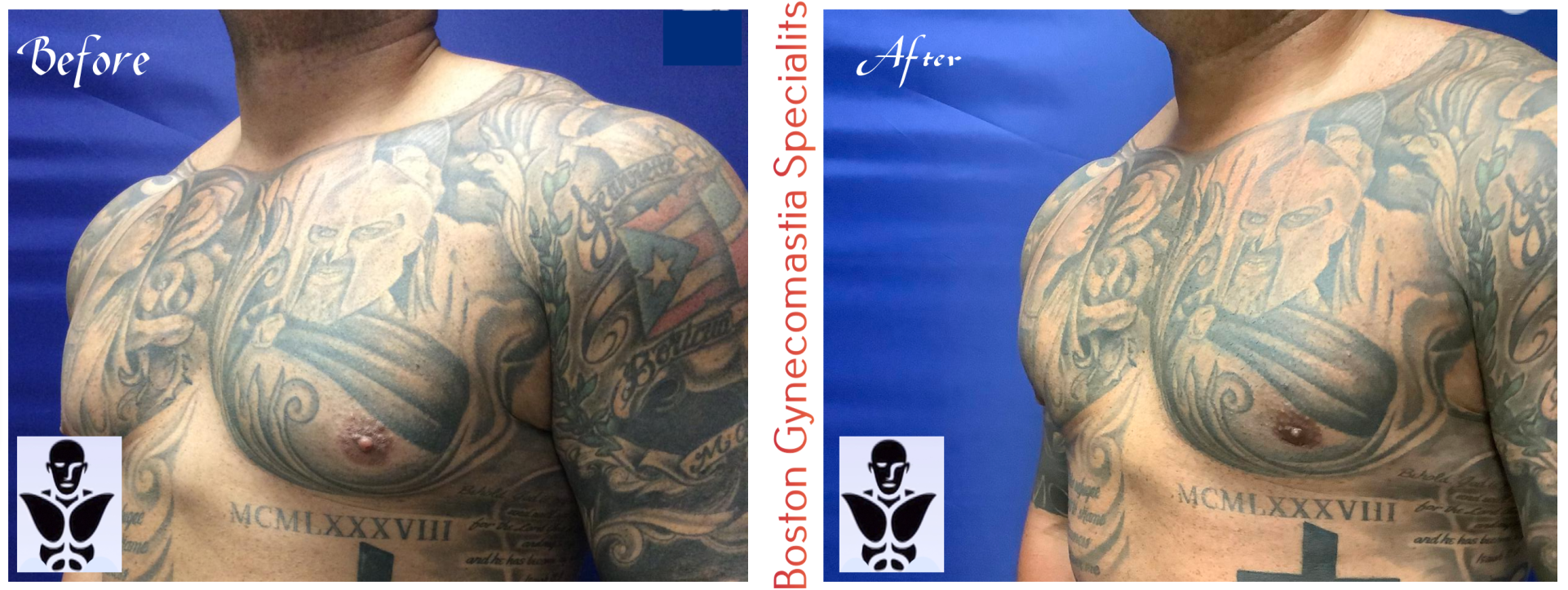 Boston gynecomastia specialists GYNO BA 21