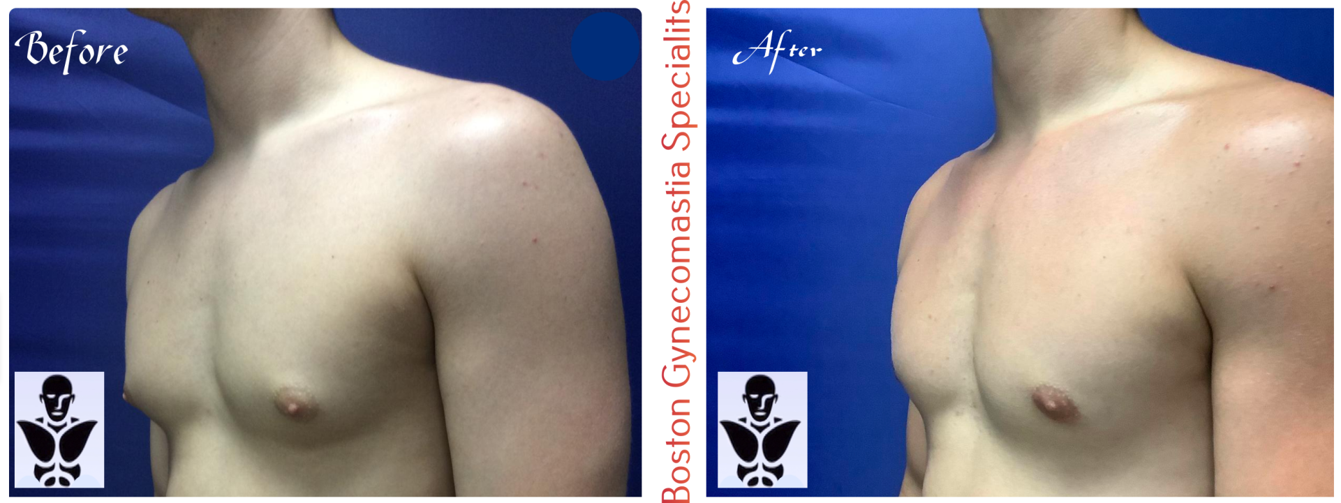 Boston gynecomastia specialists GYNO BA 27