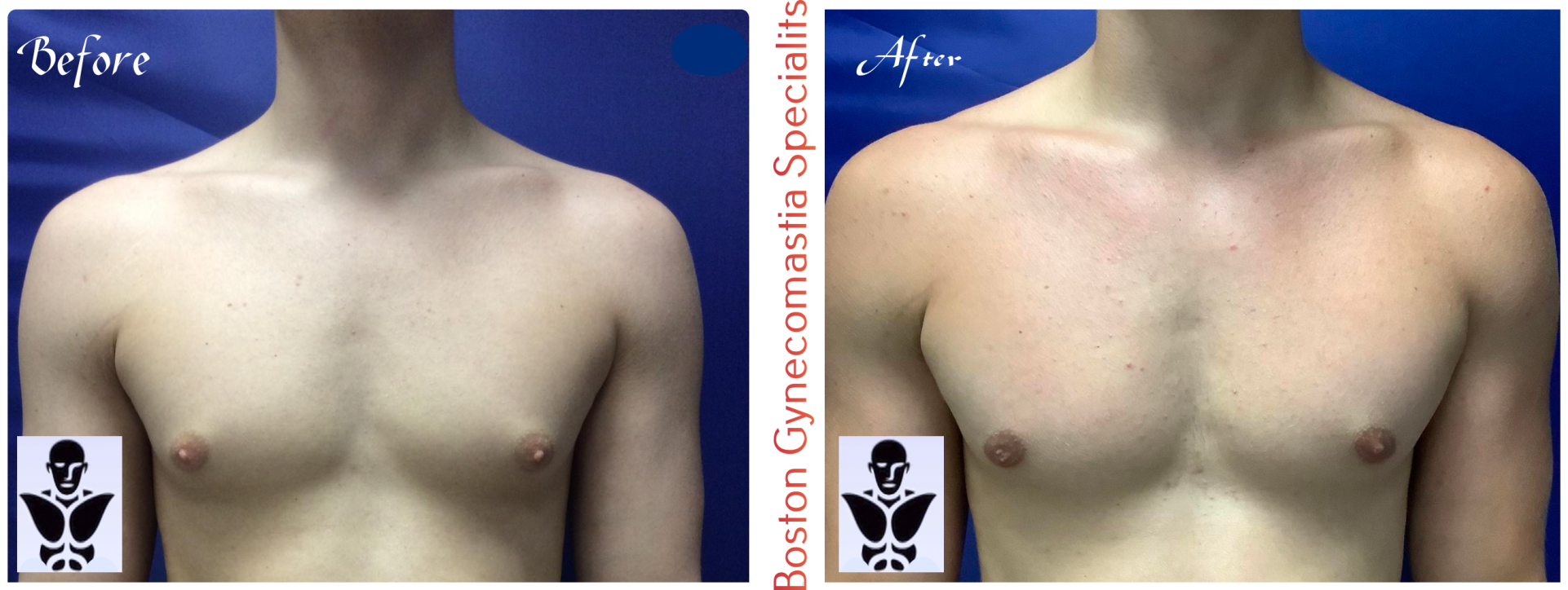 Boston gynecomastia specialists GYNO BA 26