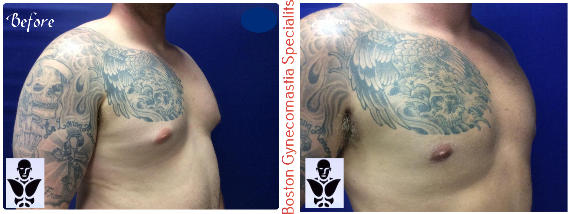 Boston gynecomastia specialists GYNO BA 34