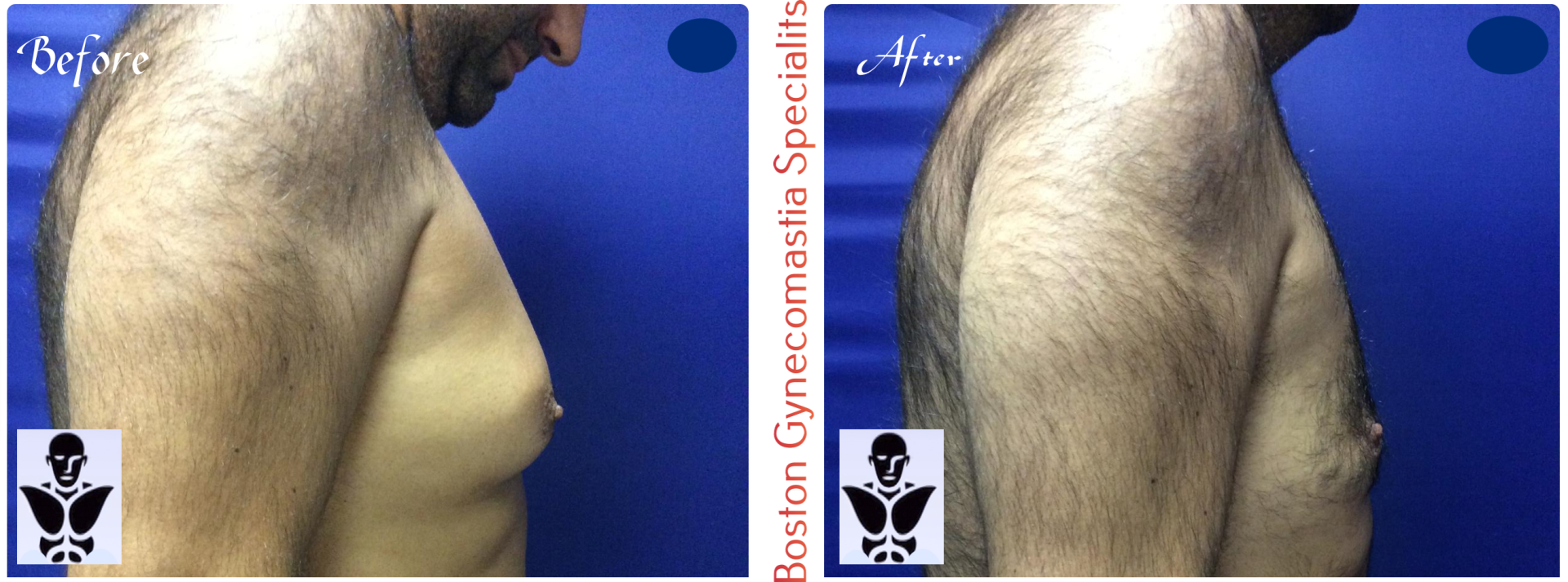 Boston gynecomastia specialists GYNO BA 3