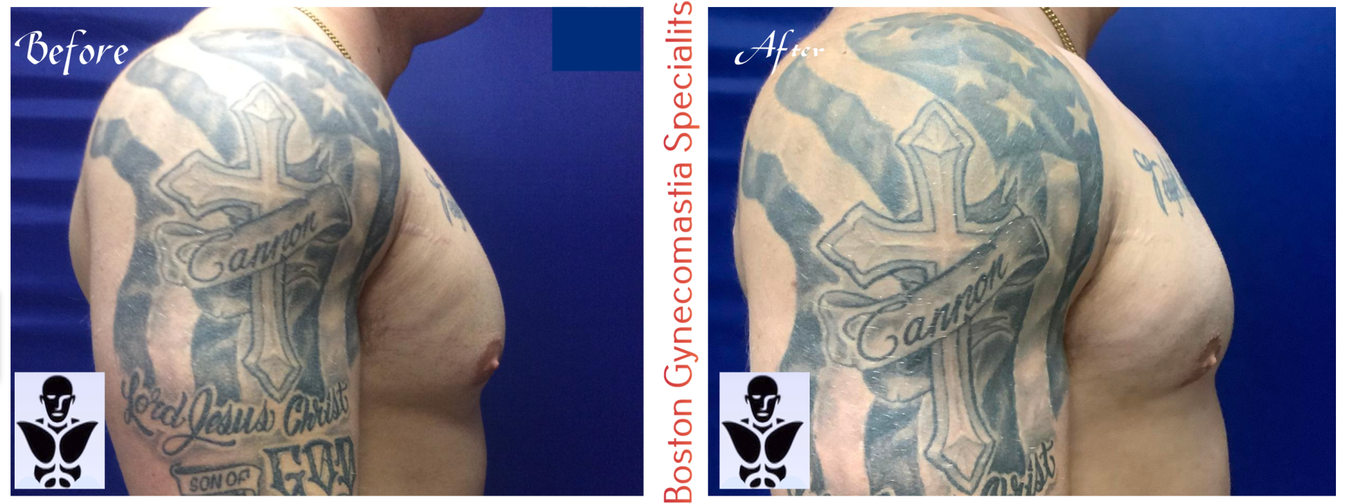 Boston gynecomastia specialists GYNO BA 14