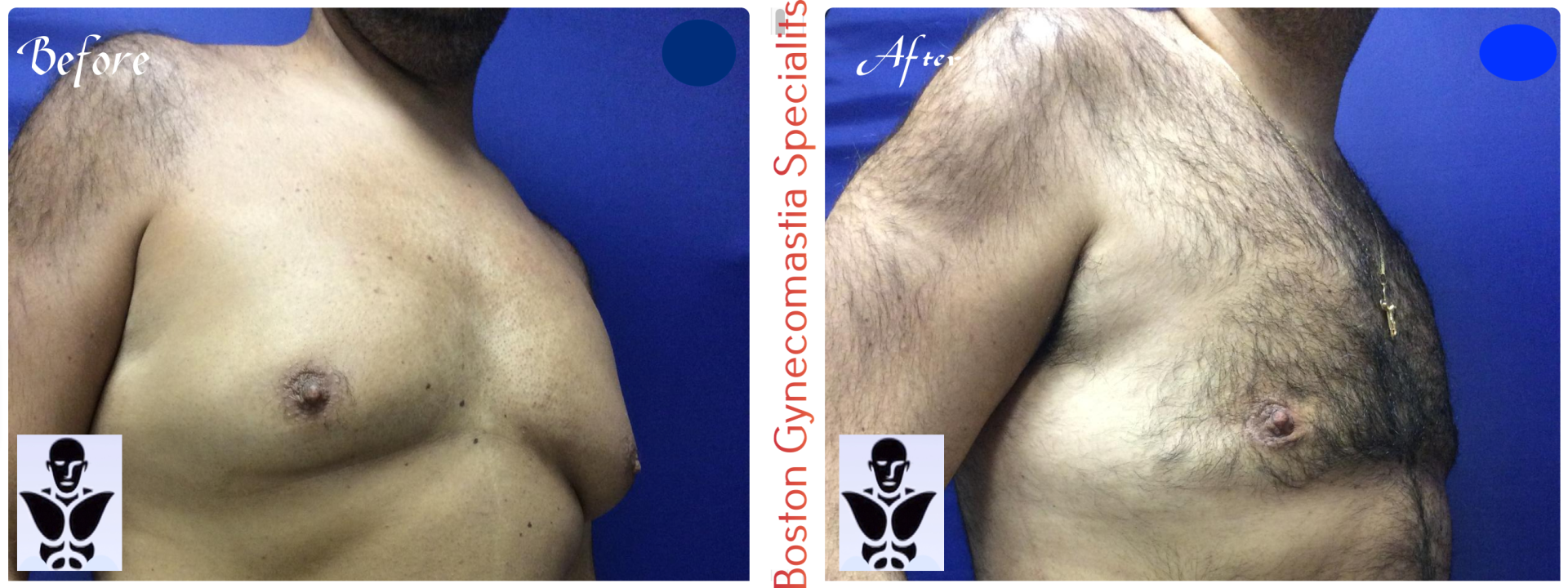 Boston gynecomastia specialists GYNO BA 1