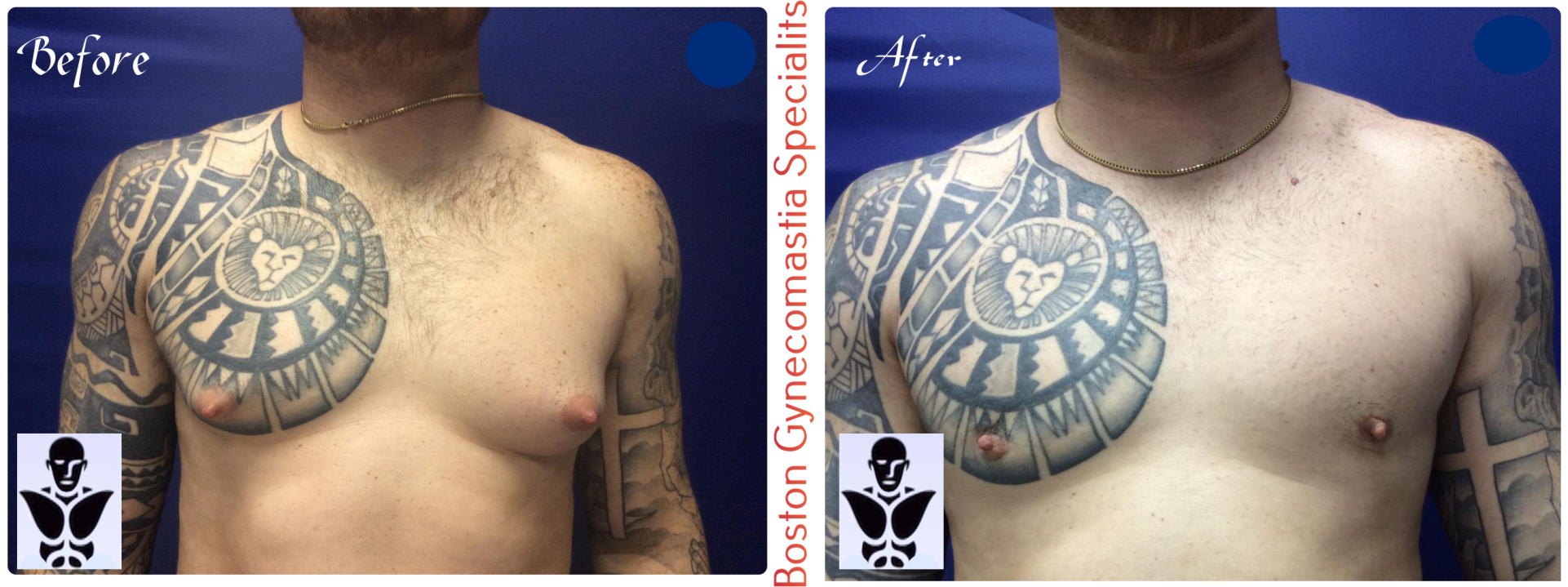 Boston gynecomastia specialists GYNO BA 32