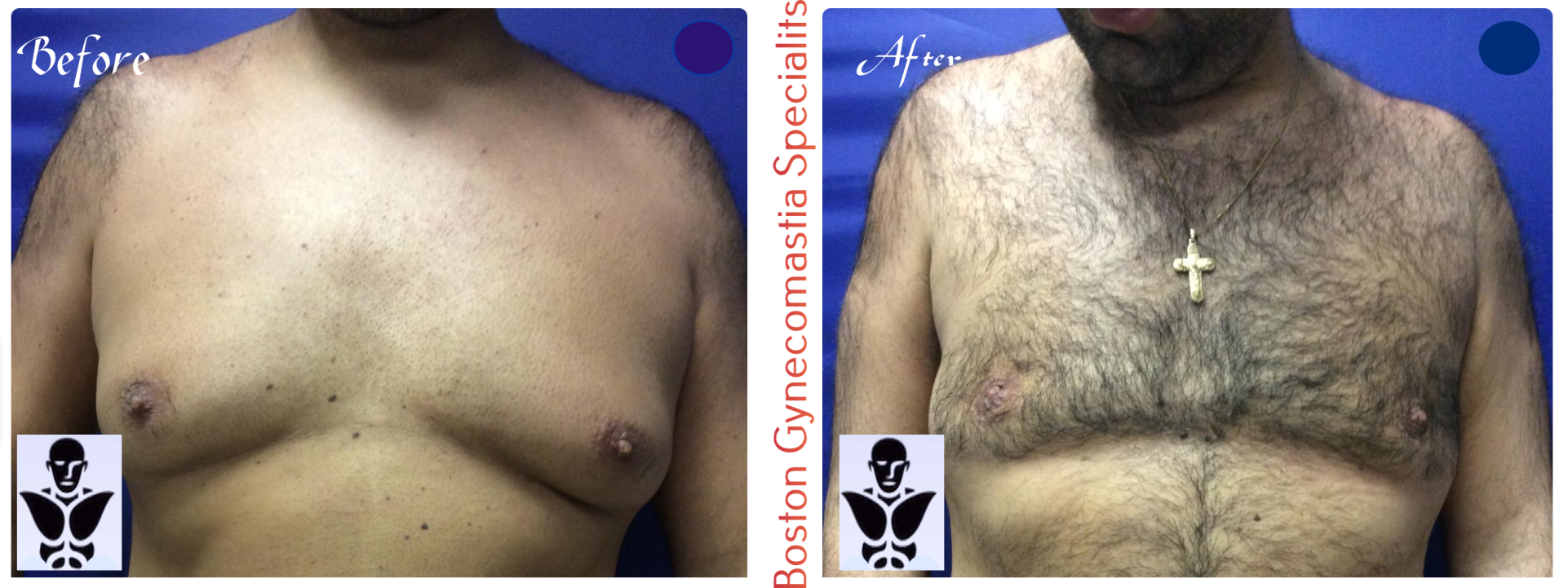 Boston gynecomastia specialists GYNO BA 2