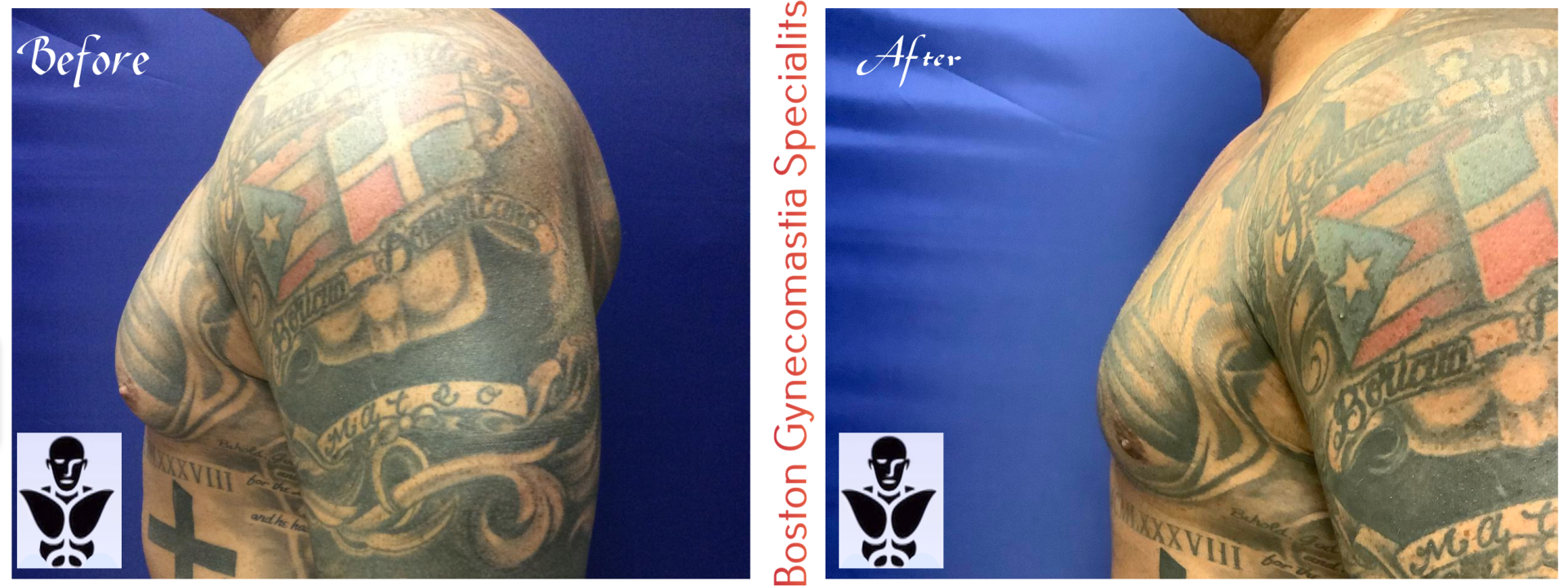 Boston gynecomastia specialists GYNO BA 22