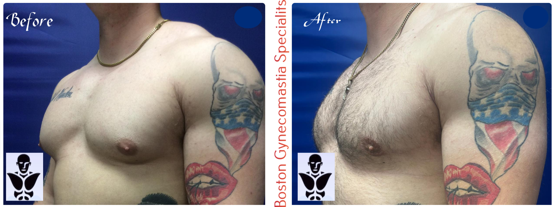 Boston gynecomastia specialists GYNO BA 8