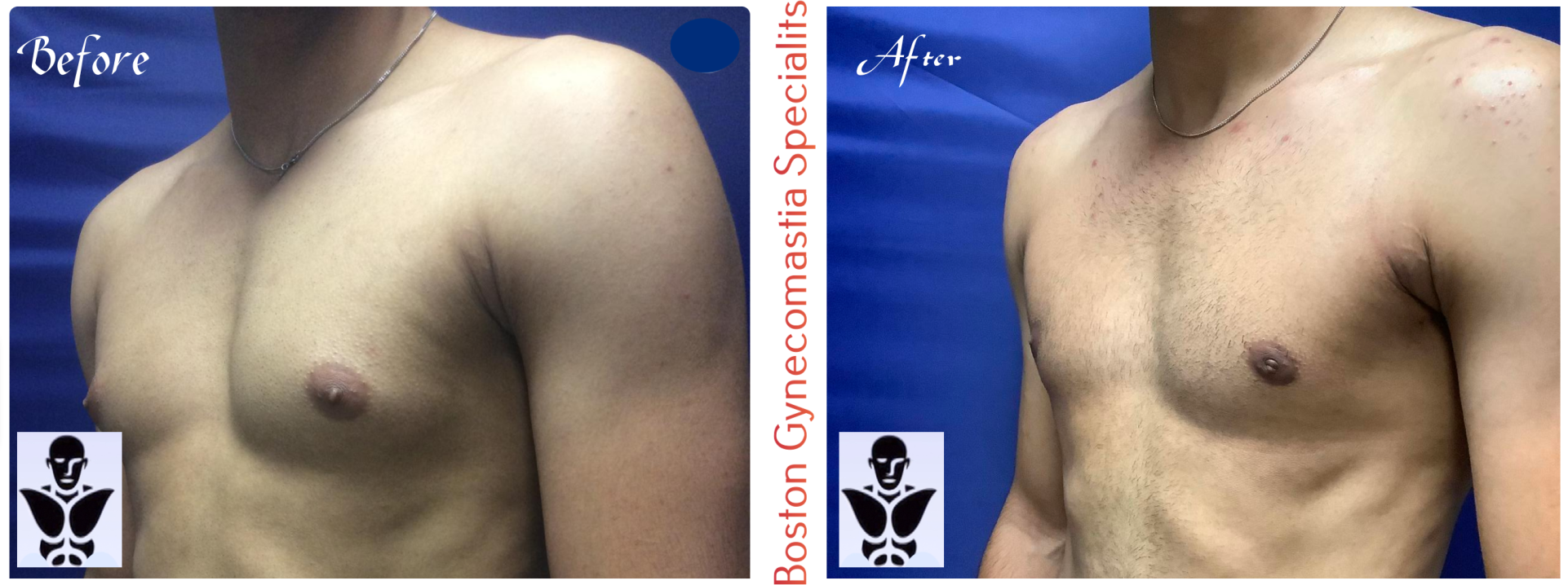 Boston gynecomastia specialists GYNO BA 15