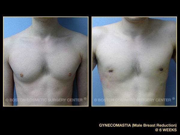 The Cosmetic Lane on X: Prominent nipples or puffy areoles can cause a  lack of self confidence & embarrassment for men Nipple reduction surgery  can reshape or reduce the size of the